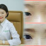 ทําตาสองชั้น คุณหมอรวงข้าว Lovely Eye By Dr.Roungkaw Clinic