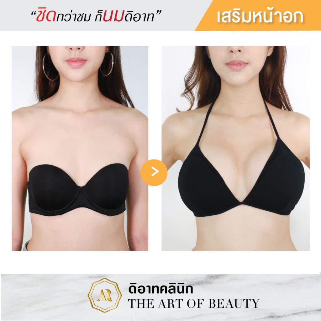 รีวิวเสริมนม