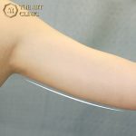 liposuction-01