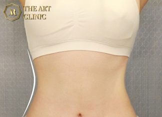 ดูดไขมันหน้าท้อง The Art Clinic