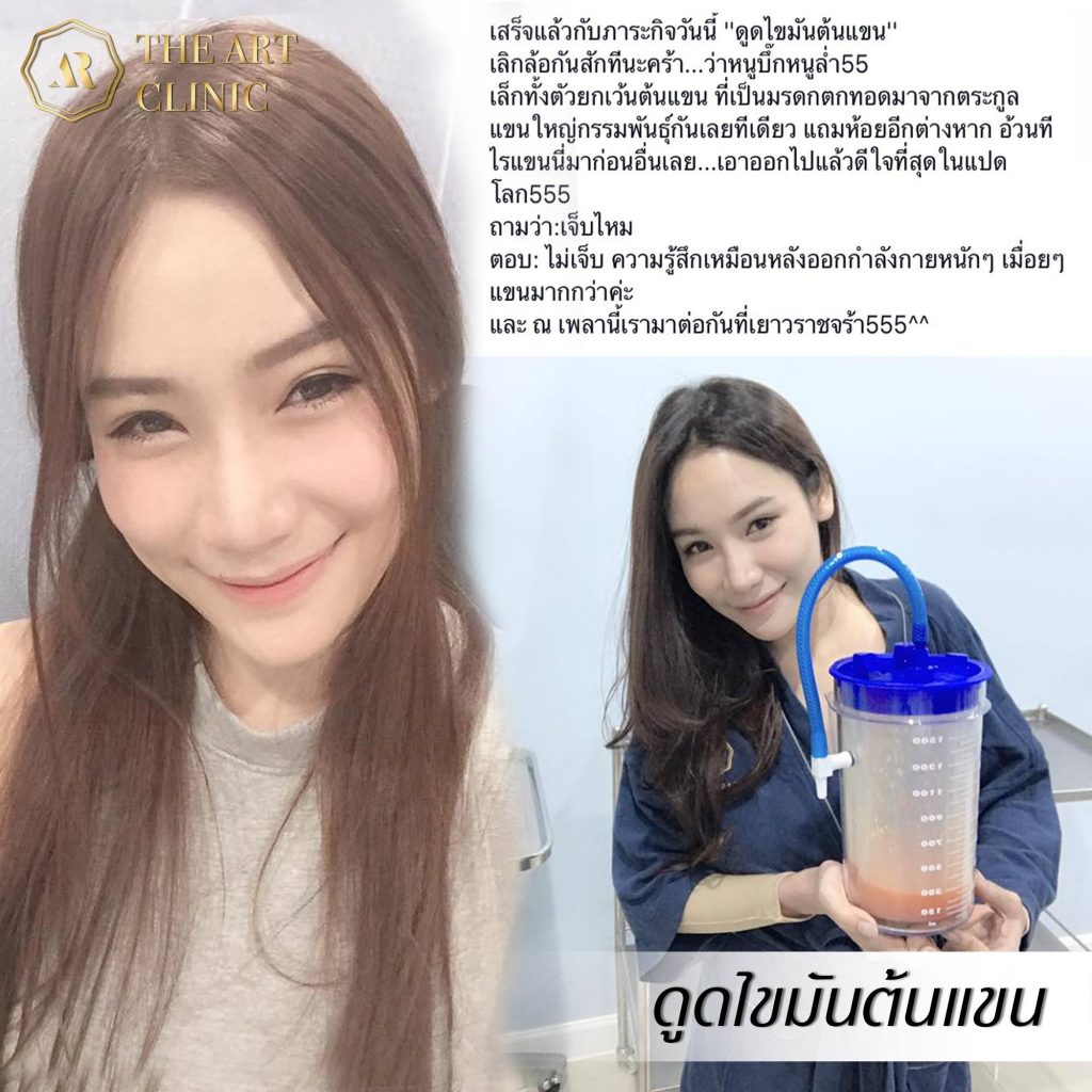 ดูดไขมันต้นแขน The Art Clinic