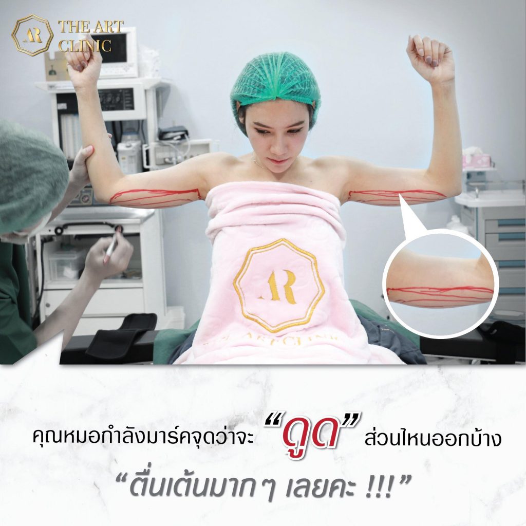 ดูดไขมันต้นแขน