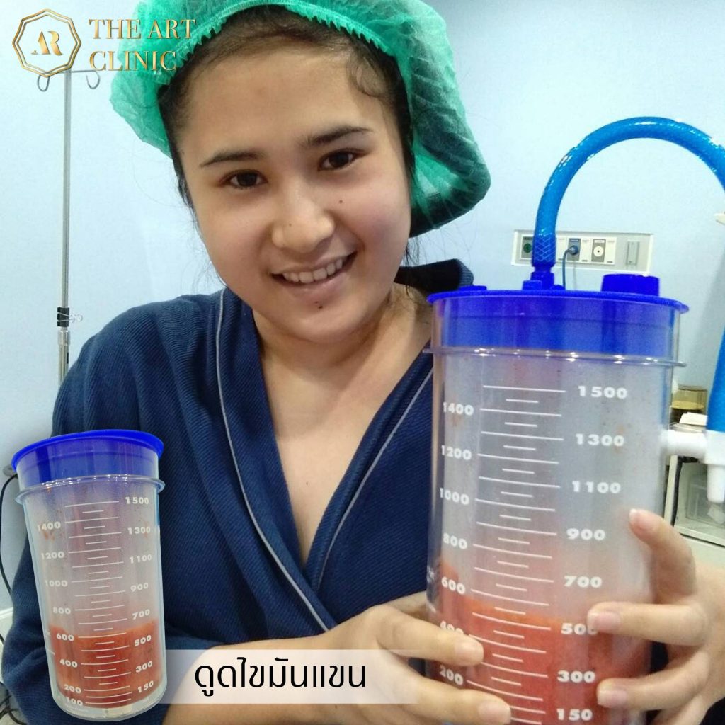 ดูดไขมันต้นแขน The Art Clinic
