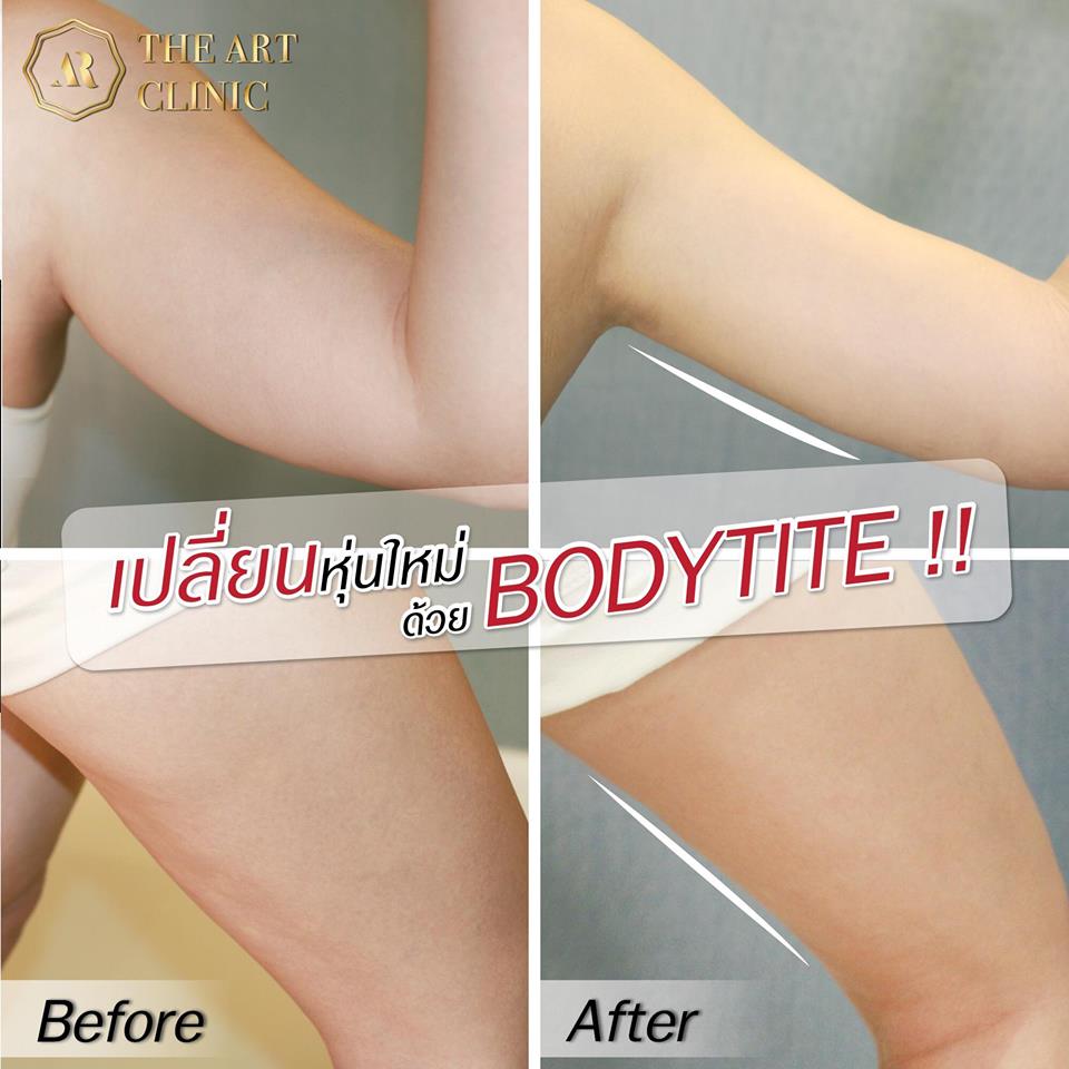 รีวิวดูดไขมัน