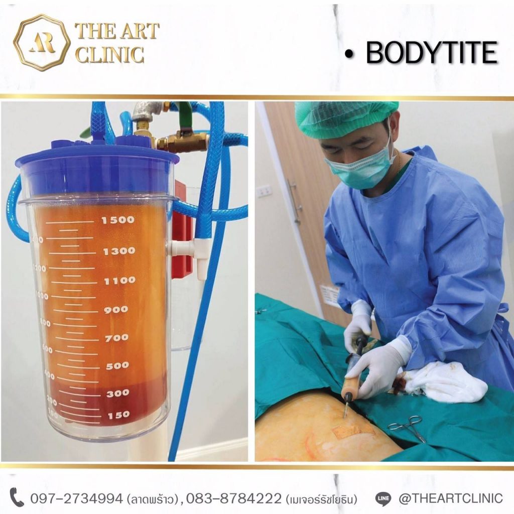 ดูดไขมันหน้าท้อง The Art Clinic