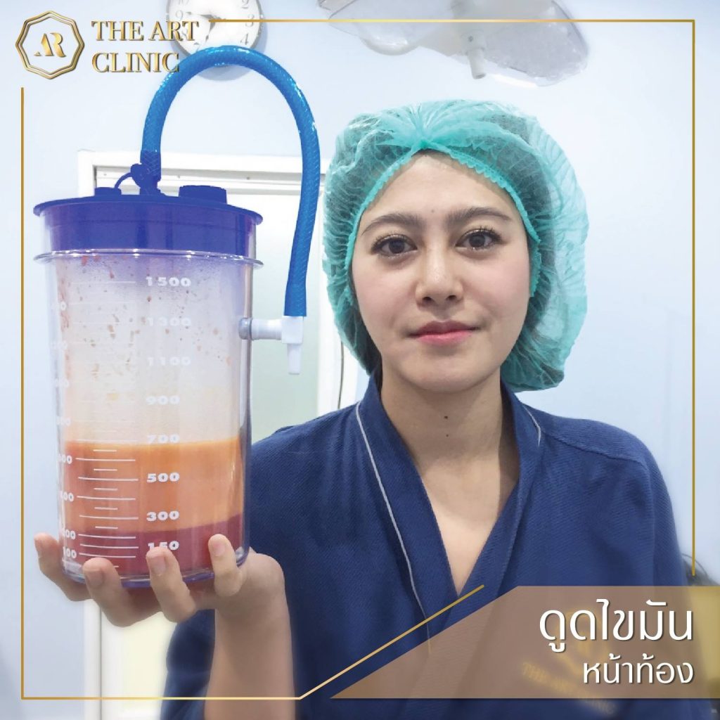ดูดไขมันหน้าท้อง