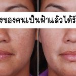 melasma-02