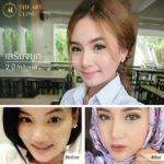 rhinoplasty-reviews-042