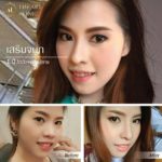 รีวิวเสริมจมูก หลังทำ 1 ปี ตะไบ+แต่งปลาย