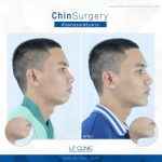 review-surgery-chin-lpclinic-04