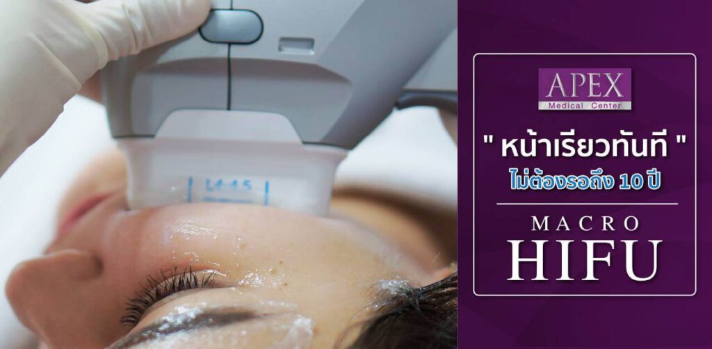 Apex clinic Macro HIFU เวอร์ชั่นใหม่ของเทคโนโลยียกกระชับ ปรับรูปหน้า เห็นผลในครั้งแรก