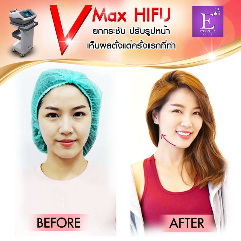 ปรึกษา HIFU ที่ เอสเตลล่า คลินิก