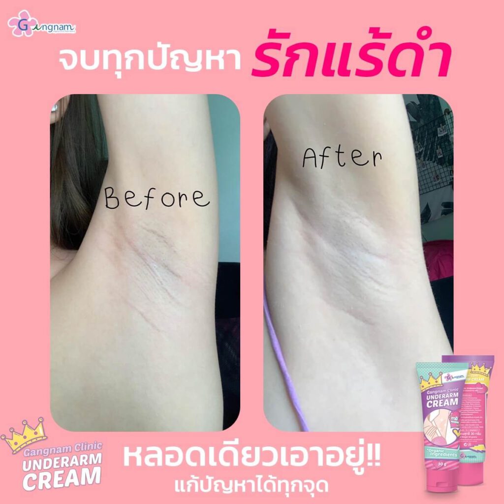 รีวิว ครีมทารักแร้ขาว Gangnam Clinic