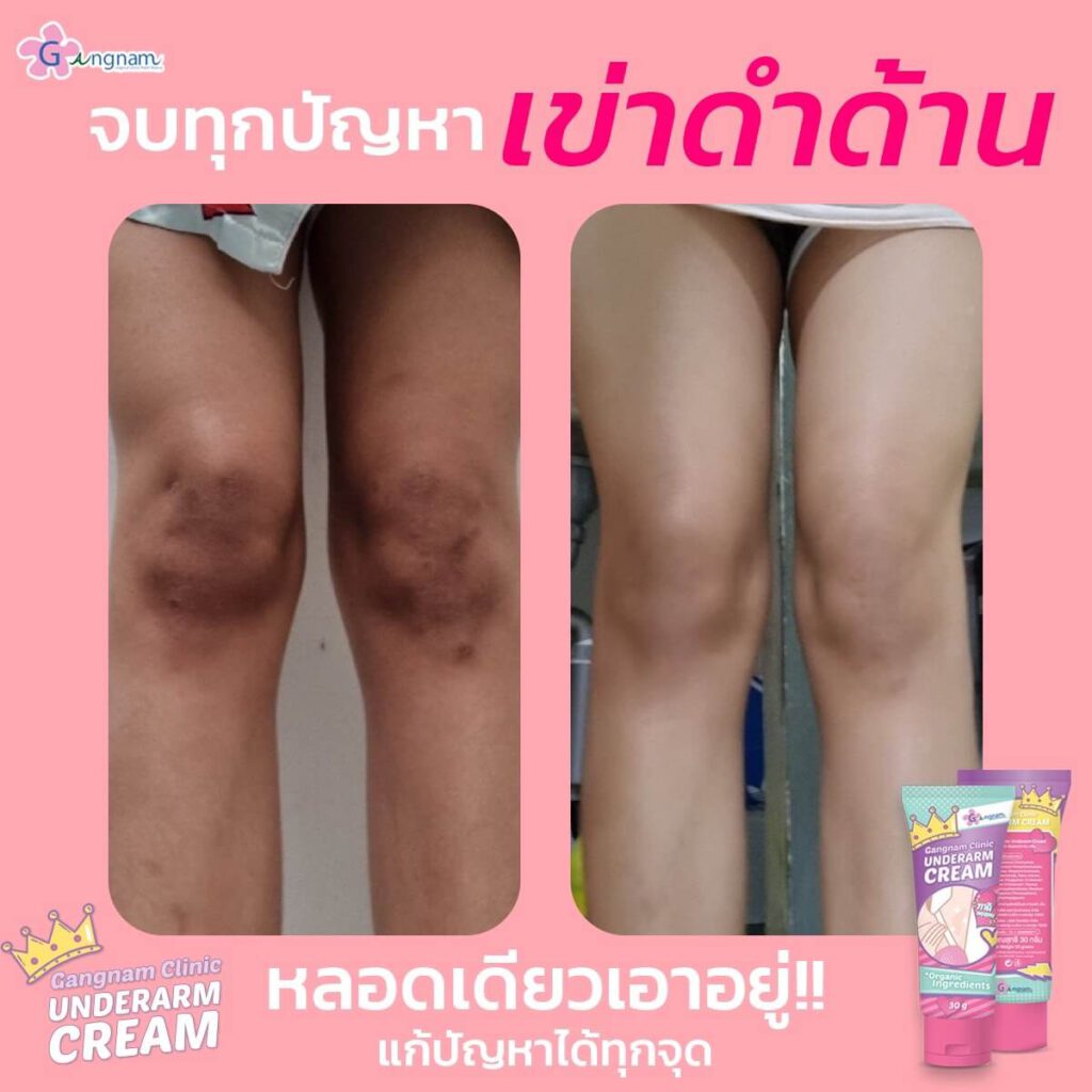 รีวิว ครีมทารักแร้ขาว Gangnam Clinic