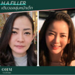 ฉีดฟิลเลอร์ที่ไหนดี ต้อง OHM clinic 1