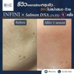 รีวิว BAC Clinic เลเซอร์หลุมสิว-1