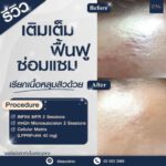 รีวิว BAC Clinic เลเซอร์หลุมสิว-3